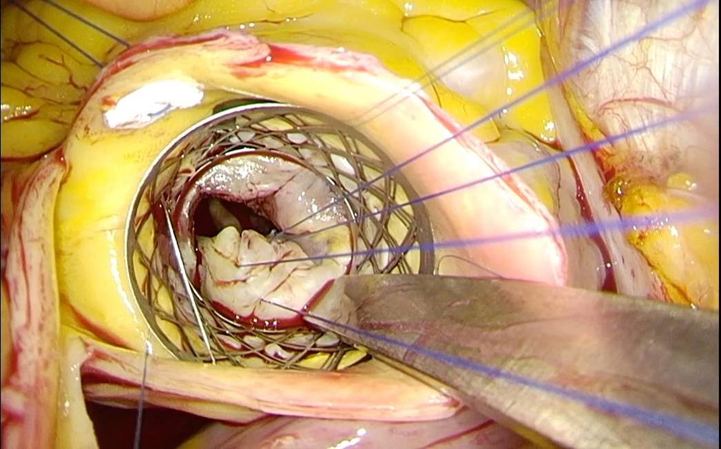 Transaortic operative view of the aortic root obtained through the right infra-axillary incision